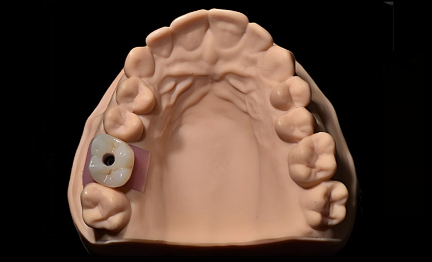 Implant  single  crowns